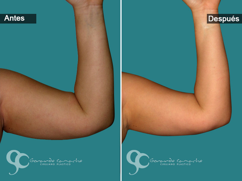 Testimonio braquioplastia Gerardo Camacho